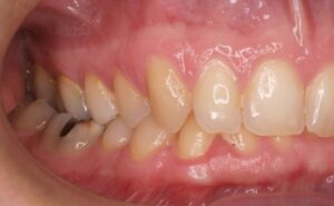 La ortodoncia sirve para corregir problemas funcionales