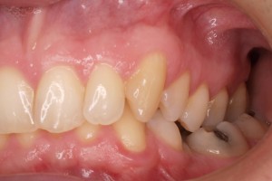 La ortodoncia sirve para corregir problemas funcionales