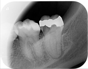 La endodoncia es un tratamiento que salva dientes 