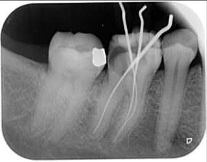 La endodoncia es un tratamiento que salva dientes 