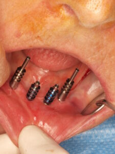 Impresión el mismo día de la cirugía - Los implantes sin cirugia y elementos de diagnóstico