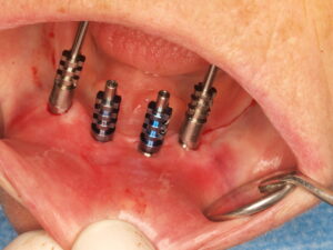 Impresión justo después de la inserción de los implantes