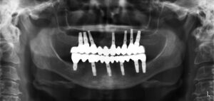 Implantes dentales ¿ por qué la diferencia en el precio ?