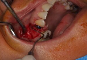Medición del hueso a obtener procedente de la tuberosidad maxilar