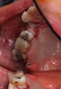 Cirugía terminada con la sutura de la tuberosidad del maxilar