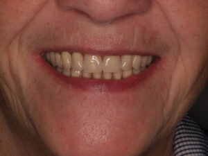 Sonrisa de paciente con implantes y prótesis removible