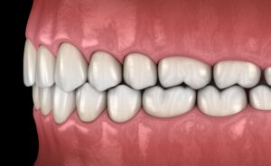 qué es la oclusión dental