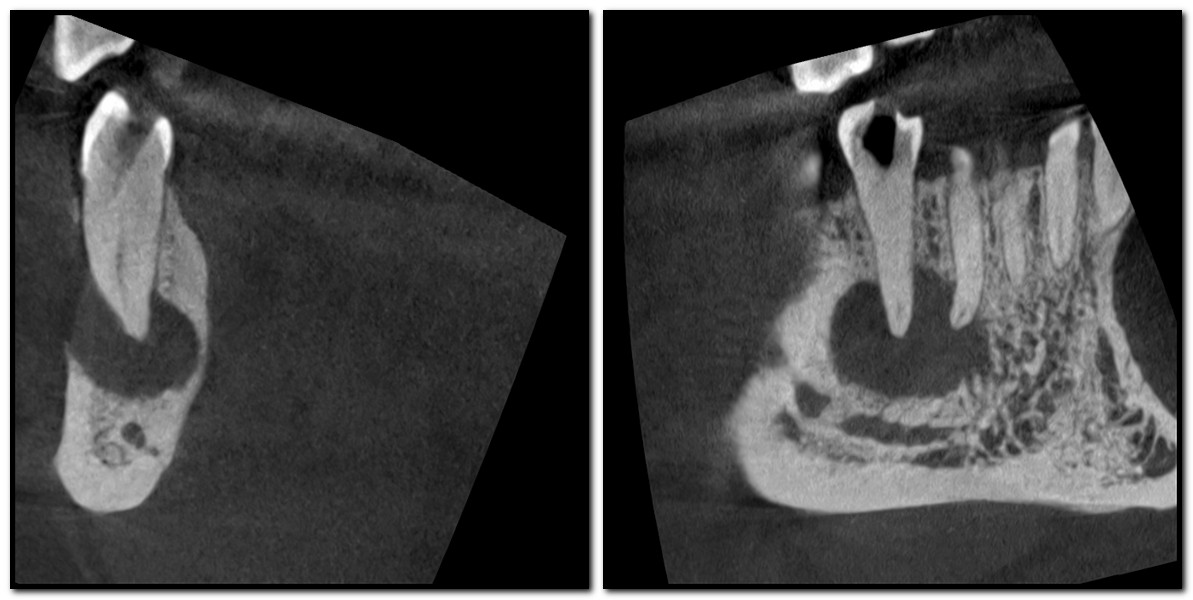 Endodoncia Lesiones Periapicales Y Regeneraci n sea Araujo Endodoncia Lesiones Periapicales Y Regeneraci n sea Araujo