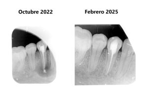 evolución de la endodoncia en una lesion periapical