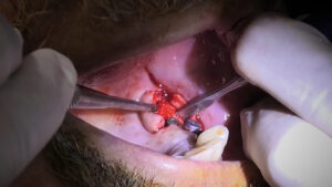 regeneración ósea en casos de implantes