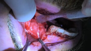 regeneración ósea en casos de implantes