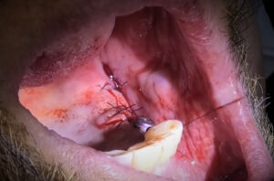 regeneración ósea en casos de implantes